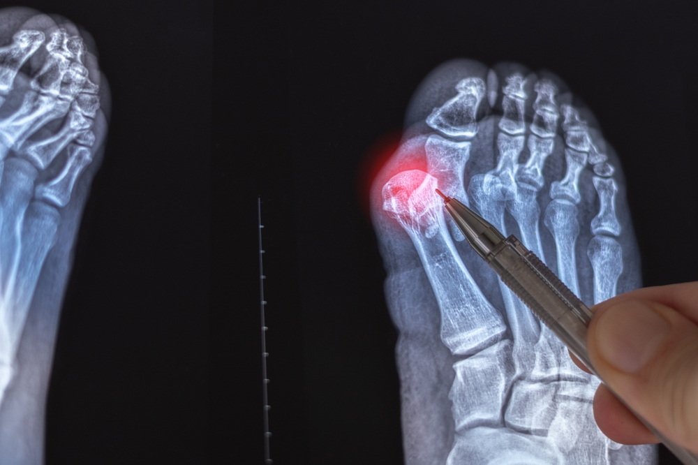 4 Types of Bunion Surgery: Which Procedure Is Best For You?