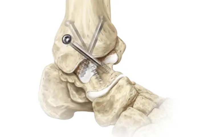 ankle 2