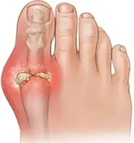 gout
